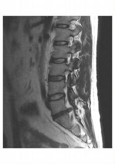 Миофасциальный массаж, миопрессура